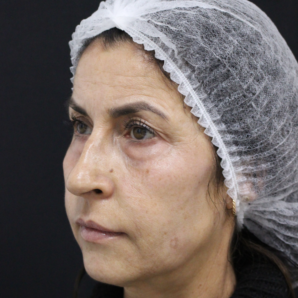 blefaroplastia-sevilla