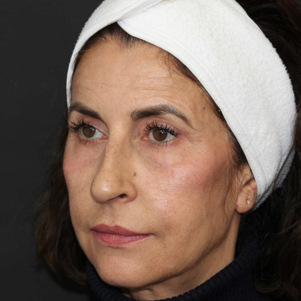 blefaroplastia-sevilla